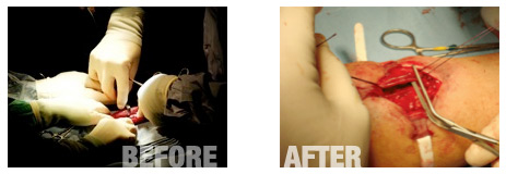 Reetrack Before and After