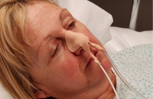 Ng tube securement device