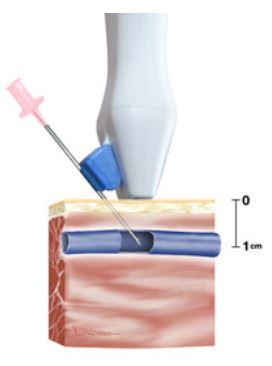 Site Rite VISION Needles Guides | Medline