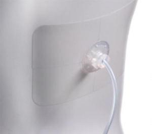 TRU-FIX Catheter Fixation Device | Medline