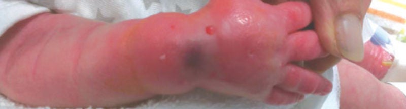 See IV PIV infiltration