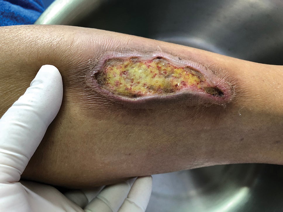 STK_Dr_Lee_Ruotsi_article_WEB_RGB (1) Gloved hand showing wound on skin.