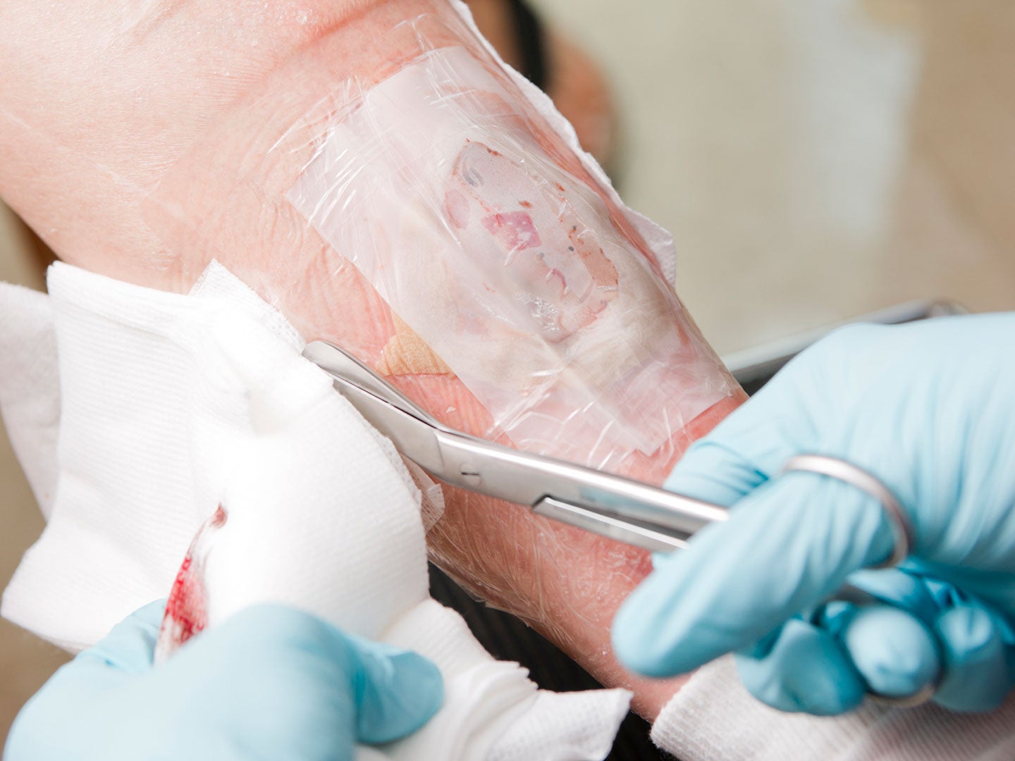 post-acute traumatic wounds Nurse trims the bandage on a traumatic wound on a patient’s leg.