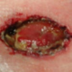 STK_wound_Mucocutaneous_Separation Mucocutaneous Separation