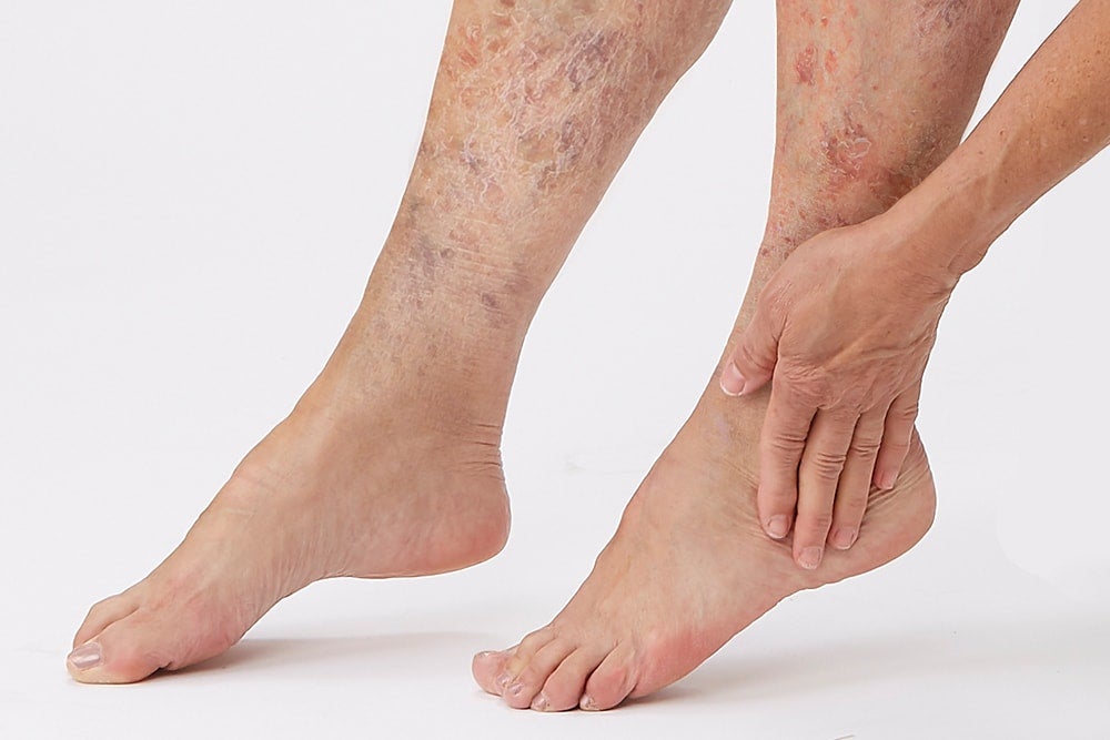 Skincare overview Patient legs showing dry skin.