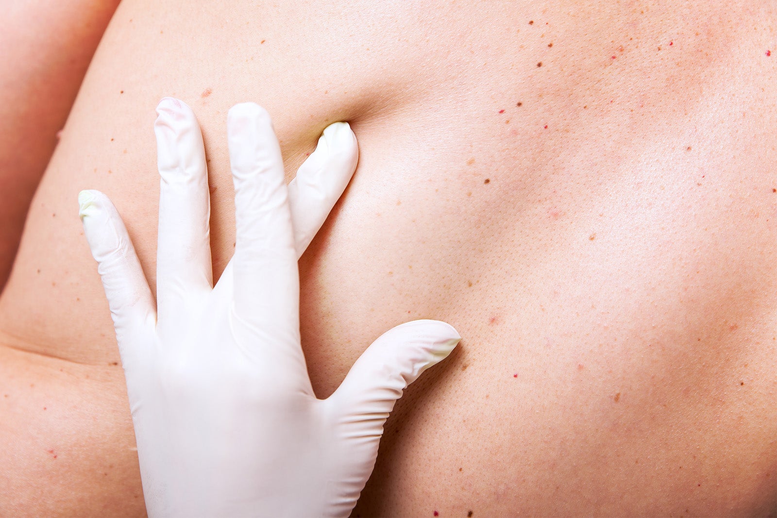 Are you doing comprehensive skin assessments correctly? Get the whole picture. Healthcare worker with gloved hand presses on a patient’s skin during a skin assessment.