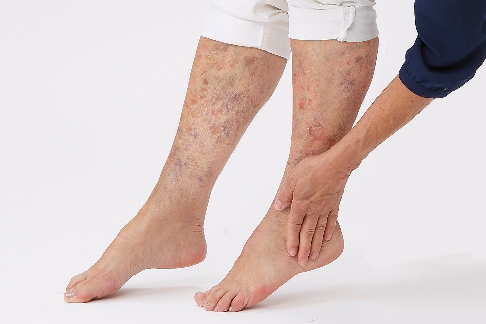 Expert Q&A: Help patients kick severe dry skin