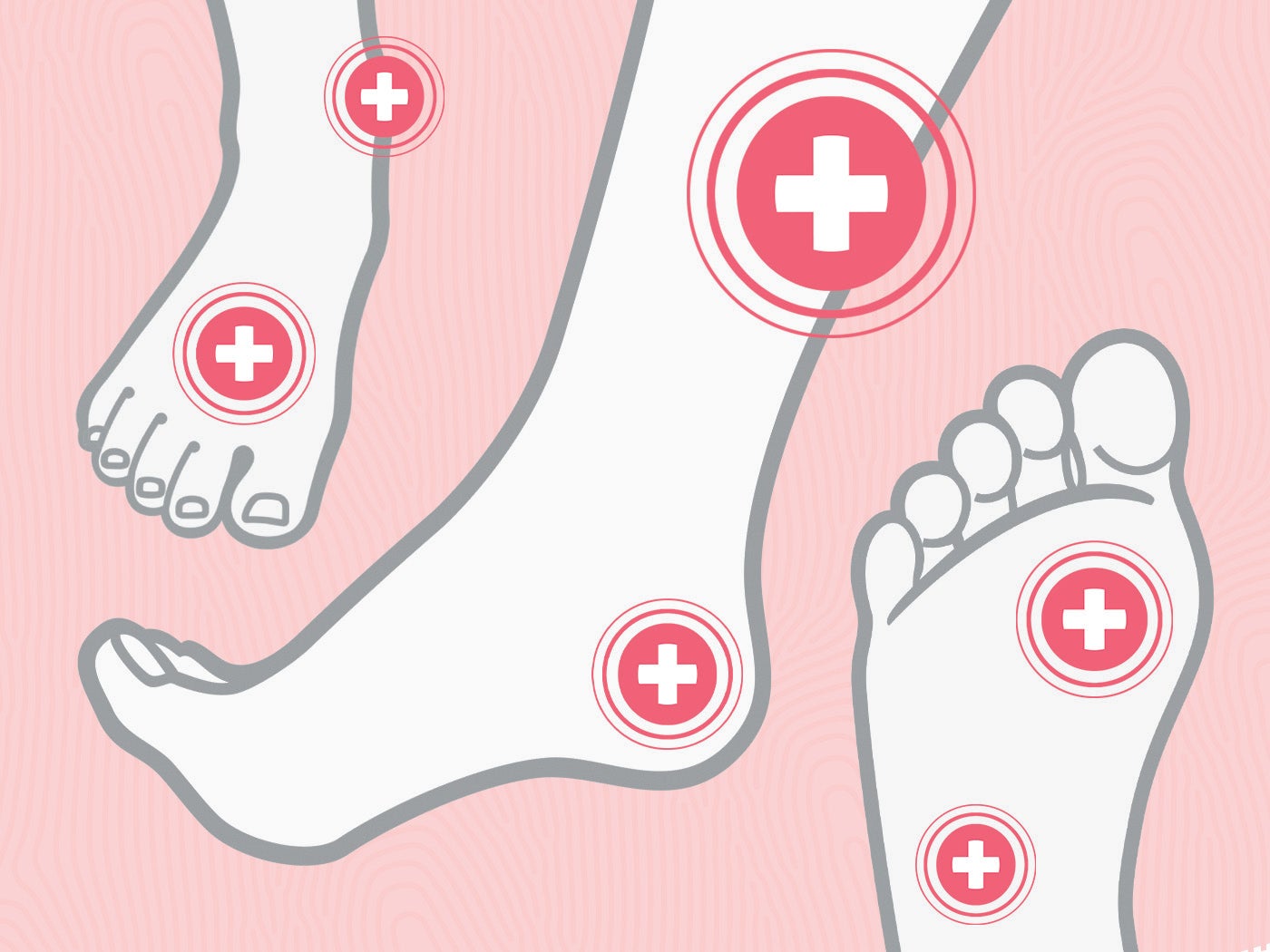 How do you distinguish the 3 most common lower extremity wounds? Share these educational posters with your team