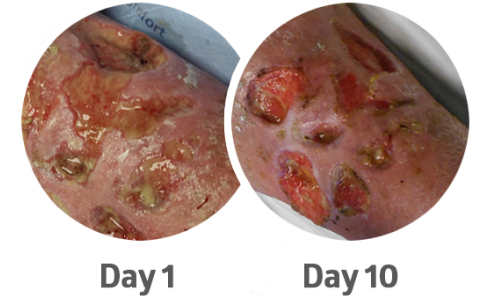 PluroGel Case Study 2_wound 1