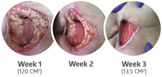 PluroGel Case Study 2_wound-2