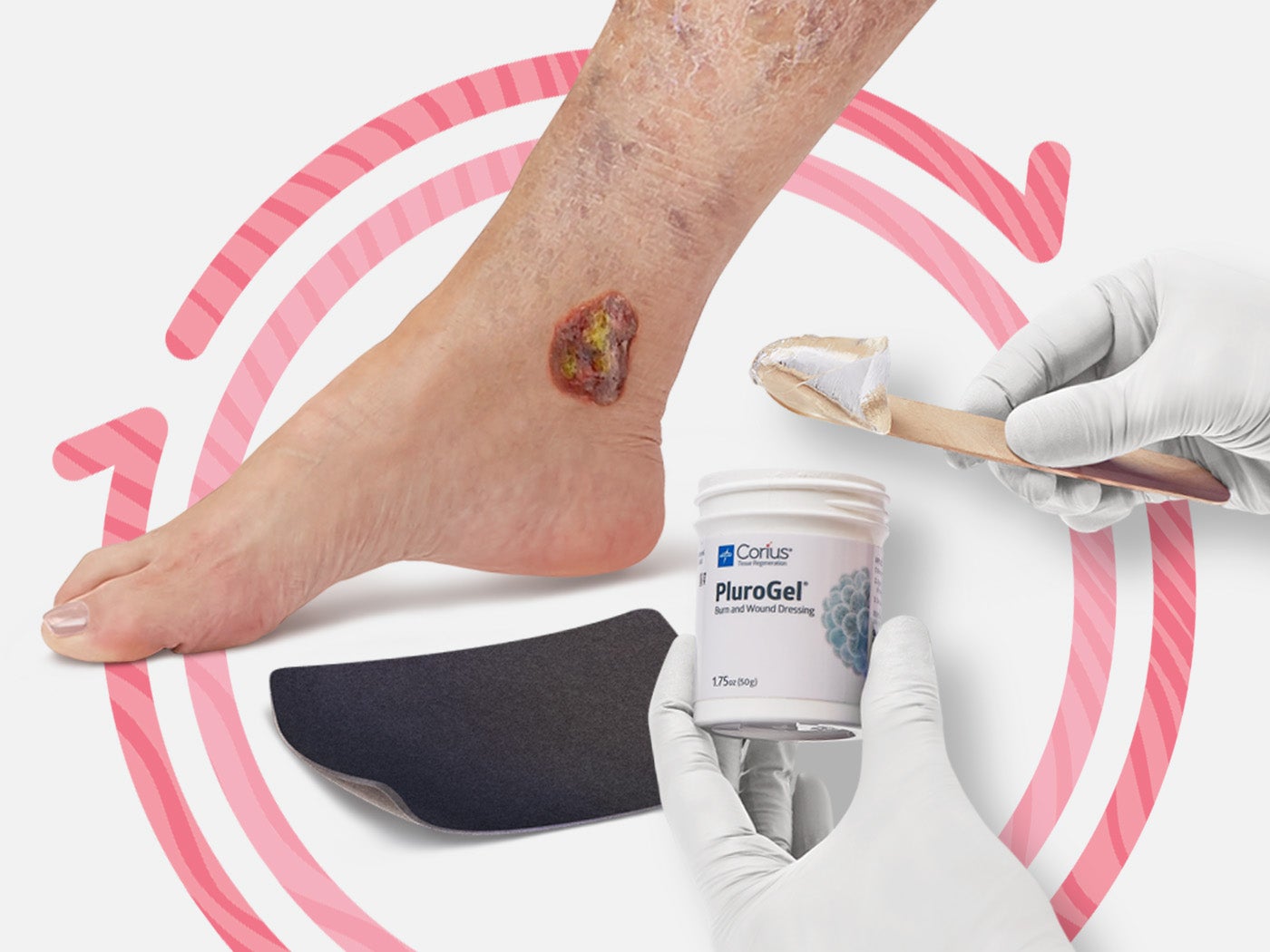 Biofilm may be the single most important cause of delayed wound healing. Biofilm may be the single most important cause of delayed wound healing.