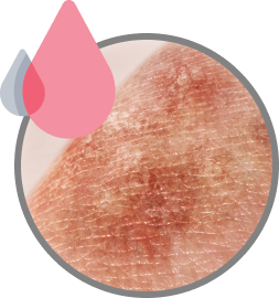 skin damage Example of skin with breakdown due to moisture-associated skin damage