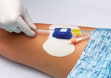 Caregiver’s gloved hand securing IUC to patient’s leg Caregiver's gloved hand securing IUC to patient's leg