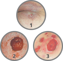 MASD condition Example of the MASD condition,Incontinence-associated dermatitis,Peristomal moisture-associated dermatitis,Periwound moisture-associated dermatitis