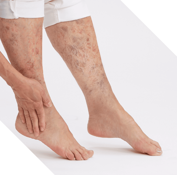 System Of Products Venous Stasis Medline