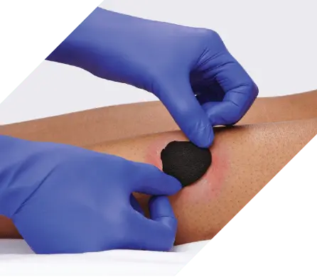 purple dressing for wounds IoPlex® Iodophor Foam Dressing