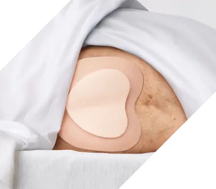 Prevent pressure injuries with a 5-layer bordered foam dressing - Medline